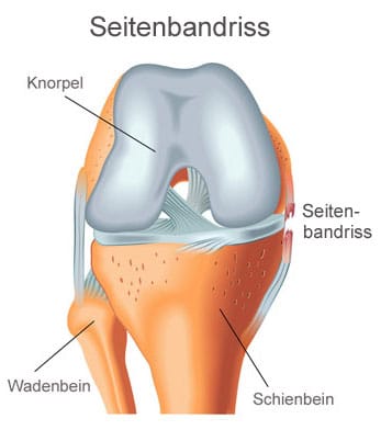 Seitenbandriss Knie