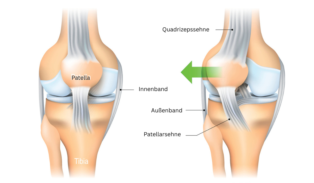 Medizinische Darstellung einer Patellaluxation mit seitlich verschobener Kniescheibe