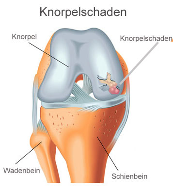 Medizinische Illustration eines Knorpelschadens im Kniegelenk mit markierter betroffener Stelle