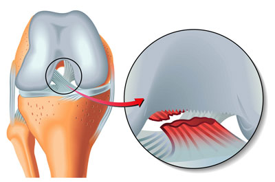 Anatomische Illustration eines vorderen Kreuzbandrisses im Kniegelenk mit markierter Verletzungsstelle