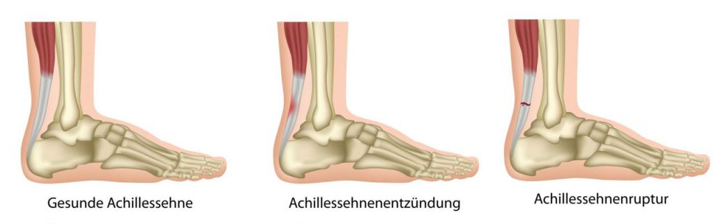 Medizinische Illustration eines Achillessehnenrisses mit markierter verletzter Sehne