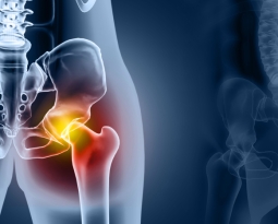 Hüftarthrose: Ursachen, Symptome und Therapie